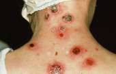 simptomy-sifilisa-u-zhenshhin[1].gif