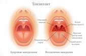 tonzillitsimptomiilechenievzroslixidetey0B177BD5.jpg