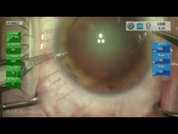 Routine Cataract Surgery Narrated Ike Ahmedx264.mp4