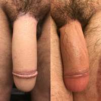 Phalloplasty-Tattoo-min.jpg