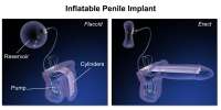 PenileImplant.png