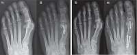 khalyus-valgus.jpg