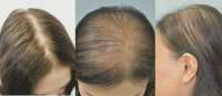 diffuznaya-alopecziya-3.jpg.webp