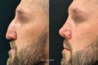 rinoplastika-2-1.jpg