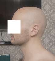 лысина.jpg