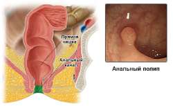 polip-analnogo-kanalas.jpg