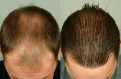 hairtransplantation3-2.jpg