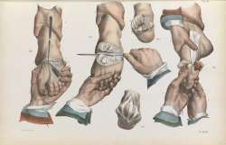 toe-amputation.jpg
