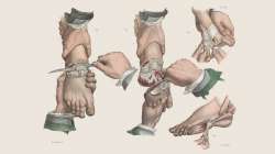 victorianfussamputationwellcomecollectionlb.jpg