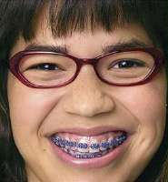 ugly-betty-brace.jpg