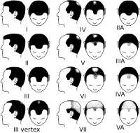PartialNorwoodscaleformalepatternbaldness.png