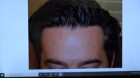 FUEHairTransplantSurgeryExtremeDensePostOpResultsDrDiep.mp4