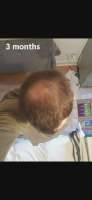 progress-2-years-on-fin-1mg-day-27yo-v0-p19qzsjs7snf1.webp