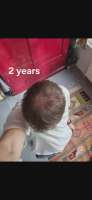 progress-2-years-on-fin-1mg-day-27yo-v0-fzylrlbt7snf1.webp