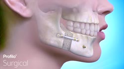 BSSO  Lower Jaw Advancement Surgery.mp4