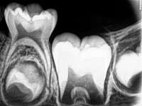 1024px-IntraoralPeriapicalRadiograph(IOPA)showingDeciduous(MilkyorPrimary)Tooth75anddevelopingcrownofPermanentorSecondaryTeeth35,36and37.jpg