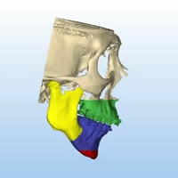 Cases of huge mandibular deficit with post-rotation are penalized not only by a very retruded profile but also by serious bite anomalies and breathing restrictions. The only solution for all these cases is a bimaxi.mp4
