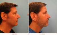 male-rhinoplasty.jpg