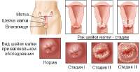 Rak-sheyki-matki-simptomy2.jpg