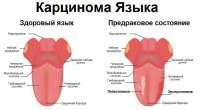leukoplakia.jpg