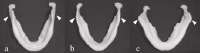 2585542Inverted-mandibles-show-three-types-of-the-gonial-angle-indicated-by-arrowheads-a-and.png