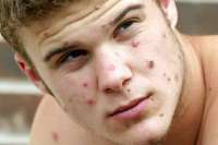 monkeypox-2-1.u6cjii.jpg