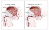 Benign-prostatic-hyperplasia-vs-normal-prostate.jpg